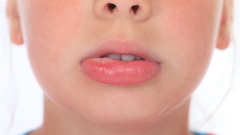 علاج طبيعي لتقرحات الفم