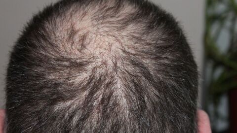 علاج طبيعي لمنع تساقط الشعر