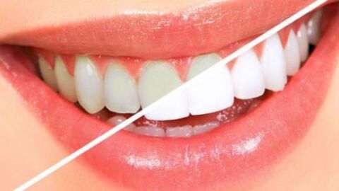 وصفة سريعة لتبييض الأسنان