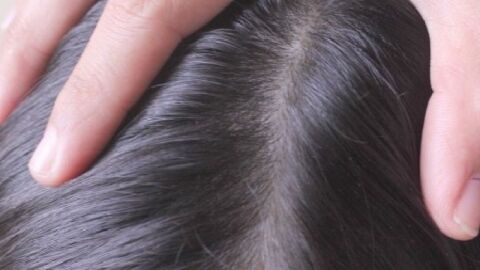 وصفة لقشرة الشعر