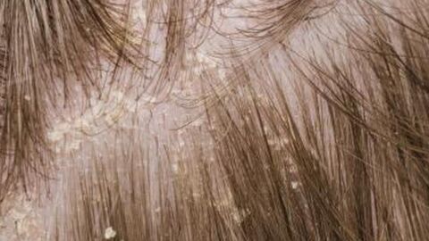 وصفة فعالة لإزالة القشرة من الشعر