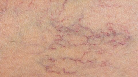 ظهور الشعيرات الدموية على سطح الجلد
