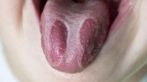 أسباب الفطريات في الفم عند الأطفال