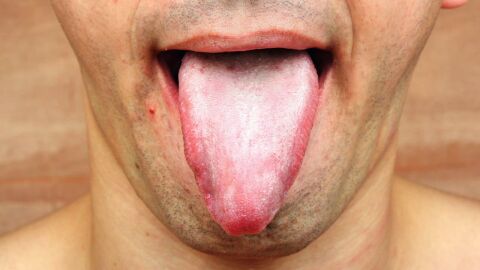 أسباب ظهور الفطريات في الفم