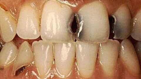 أسباب نخر الأسنان
