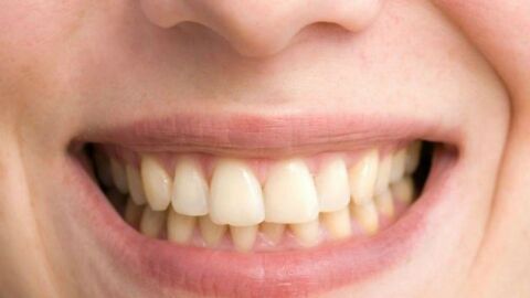 أسباب اصفرار الأسنان