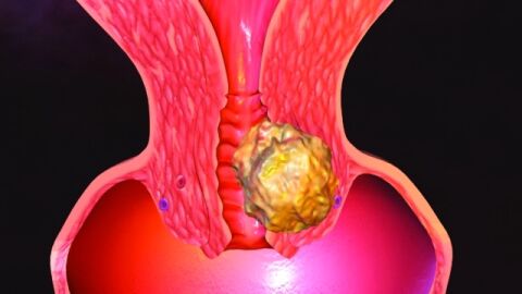 سرطان عنق الرحم وأعراضه