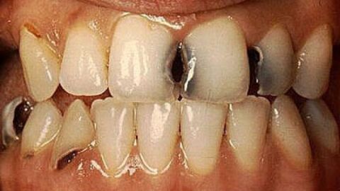 تعريف تسوس الأسنان