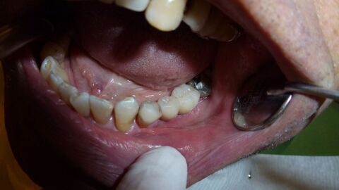 آثار زراعة الاسنان