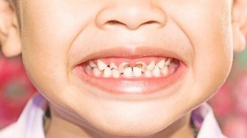 فقدان الأسنان عند الأطفال في مكان متسخ ودور الأهل - فيديو