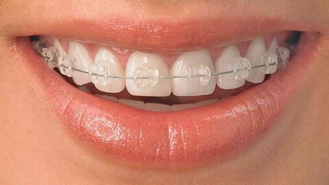 عيوب التقويم الشفاف للأسنان