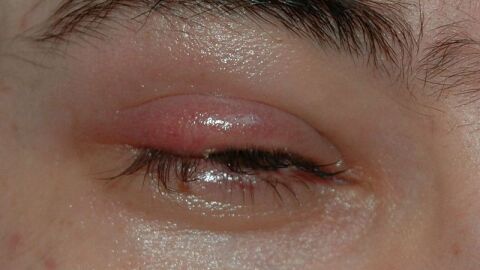 التهاب جفون العين