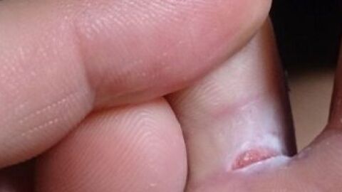 فطريات بين أصابع القدم وعلاجها