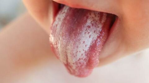 الفطريات في الفم عند الرضع