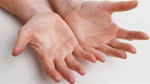 علاج فطريات اليد