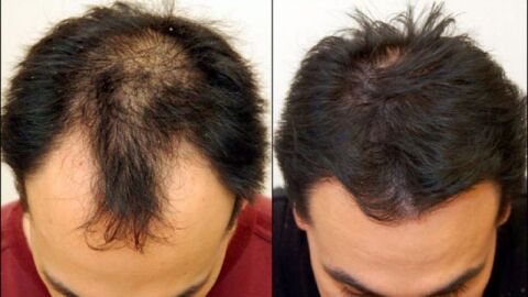 علاج تساقط الشعر والصلع