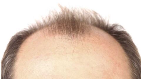 علاج تساقط شعر مقدمة الرأس