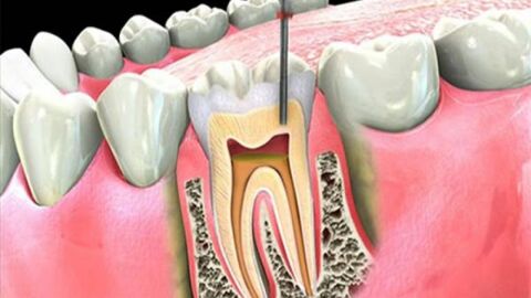 علاج عصب الأسنان في البيت