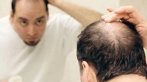 كيف توقف تساقط الشعر عند الرجال