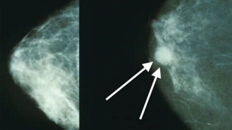 كيف يتم اكتشاف سرطان الثدي