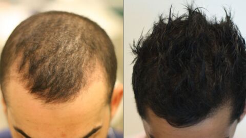 كيف تتم عملية زراعة الشعر