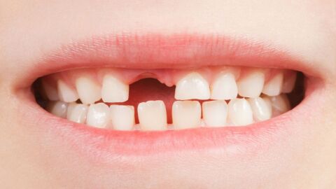 كم عدد الأسنان المؤقتة عند الطفل