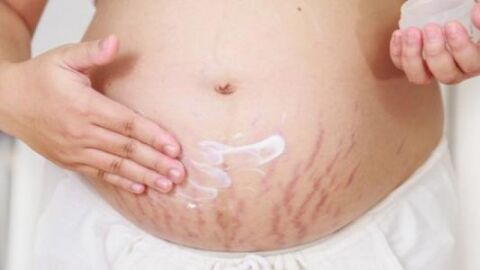 كيف تتجنب الحامل تشققات البطن