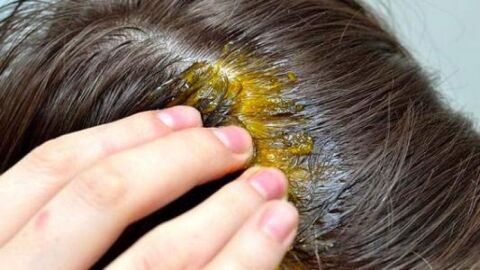 طريقة للقضاء على حشرات الشعر