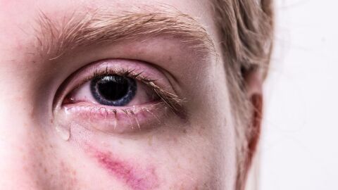 كيفية التخلص من حساسية العين