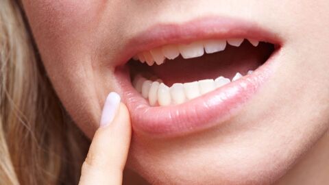 كيفية التخلص من فطريات الفم