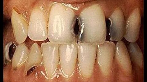كيف تتخلص من تسوس الأسنان