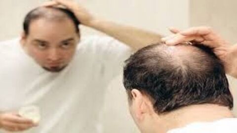 كيف تمنع سقوط الشعر