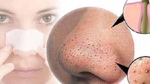 كيفية إزالة البقع السوداء من الوجه بطريقة طبيعية