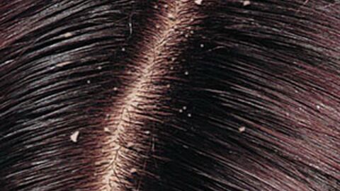 طريقة علاج قشرة الشعر