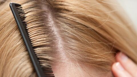 كيف أعالج قشرة الشعر