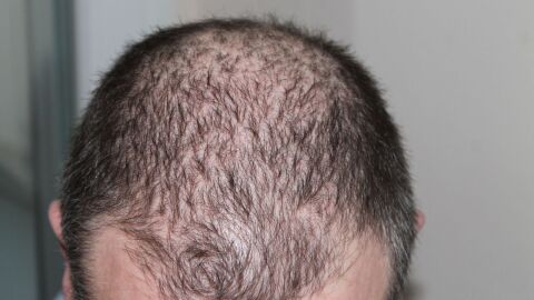 طريقة علاج تساقط الشعر عند الرجال