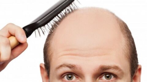 كيف تعالج تساقط الشعر عند الرجال
