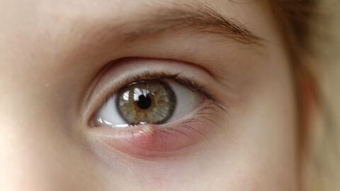 طريقة علاج جنجل العين