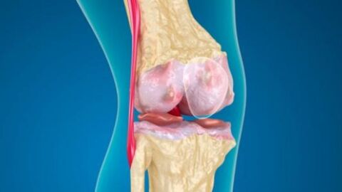 كيفية علاج قطع غضروف الركبة