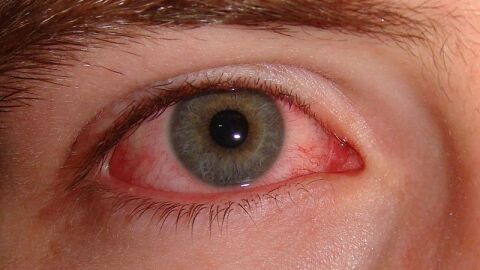 كيفية علاج احمرار العين