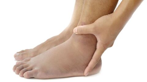 كيفية علاج تورم القدمين