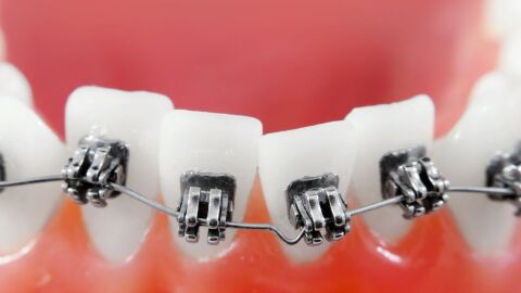 معلومات عن تقويم الأسنان