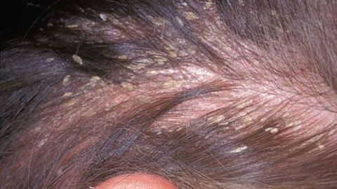أضرار القمل على الشعر