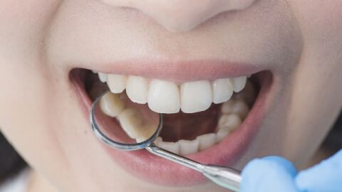 وسائل لإزالة الجير من الأسنان