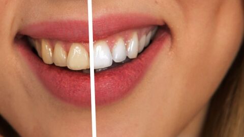 طريقة لجعل الأسنان بيضاء