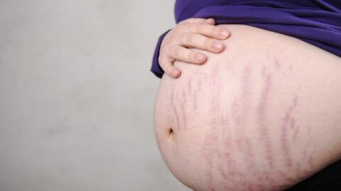 طرق لإزالة تشققات البطن بعد الولادة
