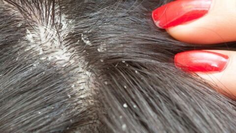 طرق معالجة القمل في الشعر