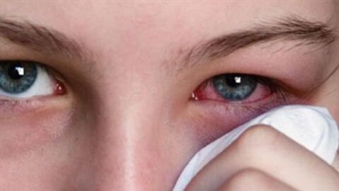 علاج رمد العيون