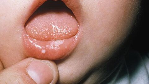 فطريات الفم عند الرضع أسبابها وعلاجها