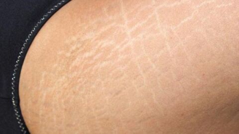 وصفة لإزالة علامات تمدد الجلد